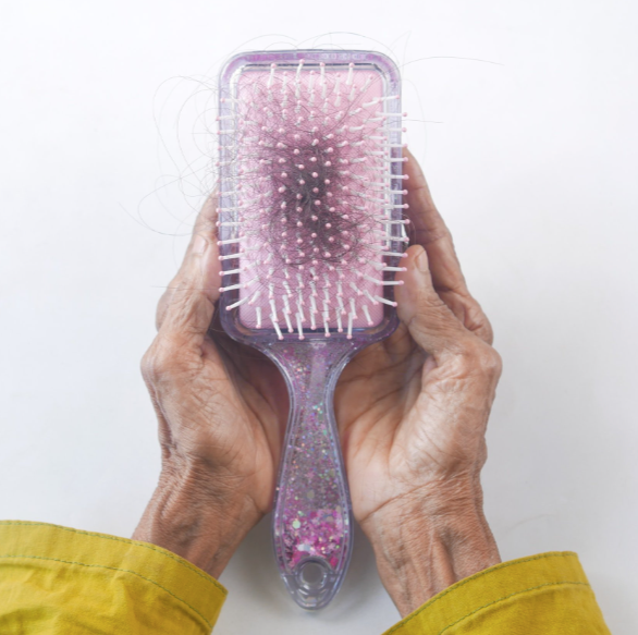 Hair Loss: What is Alopecia?